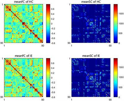 Local structural-functional connectivity decoupling of caudate nucleus in infantile esotropia